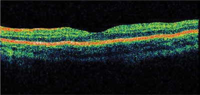 Figure 1b. Normal OCT of the left eye. 