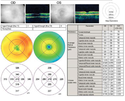 Figure 1c. OCT retinal thickness map on presentation.