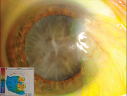 Figure 1. This patient has a dense brunescent cataract and a large pterygium that is inducing a large degree of irregular astigmatism as shown on topography (inset).