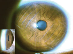 Figure 2. This patient has a severe posterior subcapsular cataract along with a severely ectatic cornea from unusual incision refractive surgery performed years prior.