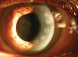 Figure 3. This patient has multiple peripheral corneal scars from prior conductive keratoplasty but a clear central cornea that has a regular and symmetric pattern of astigmatism on topography.