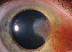 Pterygium involving the bulbar conjunctiva and cornea of the right eye (Patient 6, Table 1).