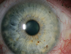 Patient with pterygium treated with excision and cryotherapy (Patient 6, Table 1). 