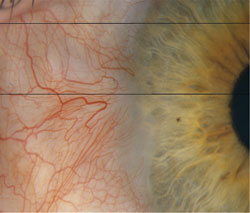 Resolution of pterygium after excision and cryotherapy.