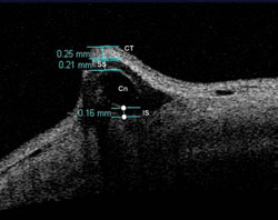 Figure 1. Anterior segment OCT.