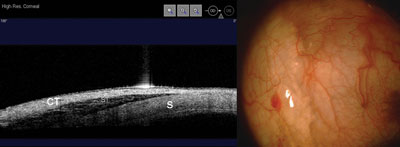 Figure 2. Anterior segment OCT image and clinical photograph of patient showing the drug in the sub-Tenon space immediately after sub-Tenon injection.