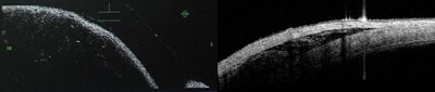 Figure 3. Anterior segment OCT image showing the difference between subconjunctival (left) and sub-Tenon (right) drug position.