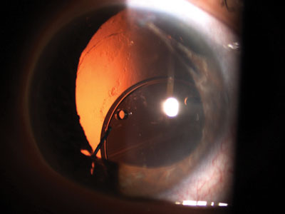 This decentered lens has positioning holes in the optic and is made of rigid PMMA, which means that it cannot easily be cut in half inside the eye; rather it must be explanted whole.