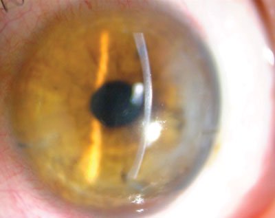 Near normal appearing cornea following DMEK with restoration of normal anatomical layers of the cornea.