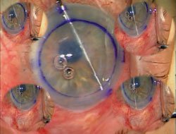 Figure 8. Case 3: Anterior synechialysis is performed prior to introduction of the donor Descemet’s membrane into the recipient anterior chamber.