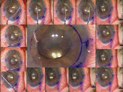 Figure 9. Case 4: Large fibrotic pupil with both anterior and posterior synechiae compromise the anterior chamber space and can potentially impede donor Descemet’s membrane introduction, unfolding and iatrogenic adherence of the membrane to the inner surface of the recipient cornea (central image); anterior and posterior synechialysis are performed before introducing the donor Descemet’s membrane (film strip).