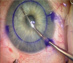 Figure 1. Case 1: An external circular 8-mm epithelial mark is made on the recipient cornea as a guide to assist in the descemetorrhexis. 