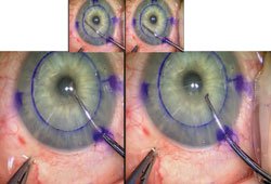 Figure 2. Case 1: John Dexatome spatula is used first to release the peripheral margins of the Descemet’s membrane in a circular manner (top row); this is then followed by removal of the Descemet’s membrane as a complete disc (bottom row).