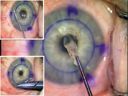 Figure 3. Case 1: The Descemet’s membrane is removed as a single disc (main figure); peripheral iridectomy is performed using John microscissors (upper insert); the temporal wound is closed with a 10-0 nylon suture (lower insert).