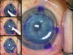 Figure 6. The loose, nonadherent epithelium is removed with a Weck-Cel spear (left film strip); proper centration of the donor Descemet’s membrane is visible (main figure).