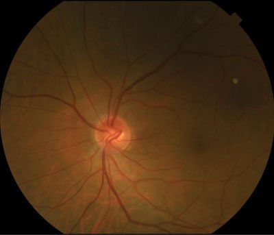 Figure 1. Fundus photograph demonstrates normal optic nerve head without obvious swelling.