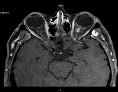 Figure 2a. MRI scan of the brain and orbits with gadolinium and fat suppression demonstrates a focal inflammatory lesion of the left optic nerve. There were no associated white matter lesions of the brain.