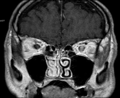 Figure 2b. MRI scan of the brain and orbits with gadolinium and fat suppression demonstrates a focal inflammatory lesion of the left optic nerve. There were no associated white matter lesions of the brain.