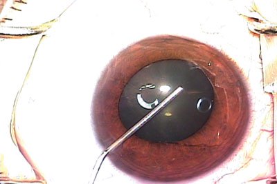 Using a blunt 27-gauge cannula, preservative-free lidocaine is injected into the anterior chamber at the beginning of cataract surgery. 