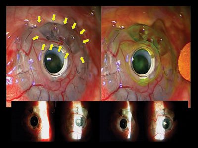 Figure 1. Intraoperative full-field and slit lamp photographs displaying extensive, recurrent corneal melt with a negative Seidel test.