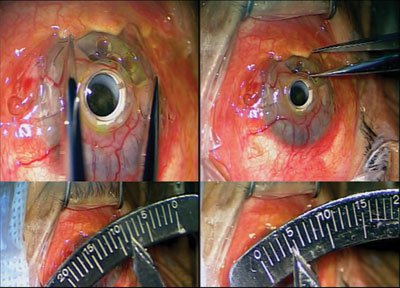 Figure 2. The area of corneal melt measured 8 mm × 4.5 mm. 