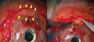 Figure 3. The previous lamellar tissue that has melted is visible. The corneal lamellar remnants are removed.