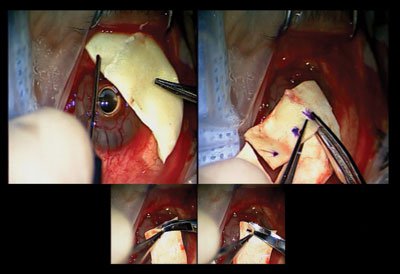 Figure 4. The donor scleral graft tissue is fashioned to cover the area of recurrent corneal melt and the keratoprosthesis plate.