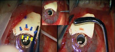 Figure 5. The donor scleral graft is attached to the recipient ocular surface with fibrin glue and 9-0 interrupted nylon sutures.