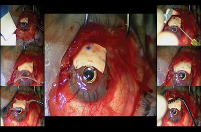 Figure 6. Amniotic membrane graft covers the scleral graft and is anchored with fibrin glue and a few interrupted 10-0 Vicryl sutures.