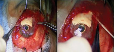 Figure 7. A second layer of amniotic membrane is placed to cover the entire cornea, scleral graft and the adjacent ocular surface.