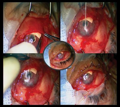 Figure 8. The conjunctiva is mobilized after making relaxing incisions, and a conjunctival flap is created to cover the scleral graft and the footplate of the keratoprosthesis. 