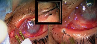 Figure 9. Punctal occlusion of the upper and lower eyelids and a lateral tarsorraphy complete the surgical procedure.