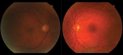 Figure 1. Dilated fundus photography. The right eye was noted to have retinal arteriolar attenuation, mildly dilated but non-tortuous retinal veins and mid-peripheral dot-blot hemorrhages. The left eye appeared within normal limits.  