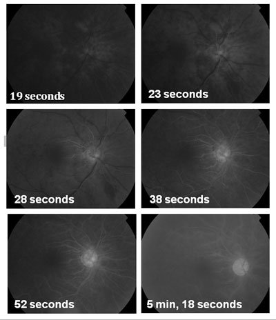 Figure 2. Fluorescein angiography of the right eye. Delayed choroidal and retinal filling are present, as well as patchy choroidal filling with delayed arteriovenous transit time. 