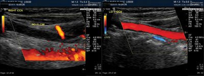 Figure 3. Carotid duplex ultrasound. Total or near total occlusion of the right common carotid artery is present. No significant disease is seen in the left common carotid artery. 