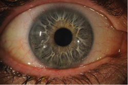 Figure 3. Slit lamp photograph at 2.5 weeks postop. Of the 15 sutures, only five remain with a bandage contact lens in place.