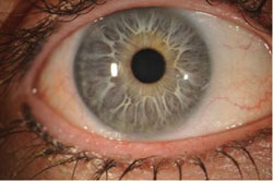 Figure 4. Slit lamp photograph at 1 month after surgery, with no signs of epithelial ingrowth.