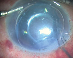 An air bubble apposes against the corneal stroma. 