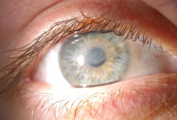 Anterior segment photo of the right eye 