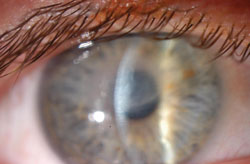 Slit beam photo of the right eye