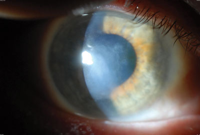 Recurrent Salzmann’s-type degeneration in the right eye.