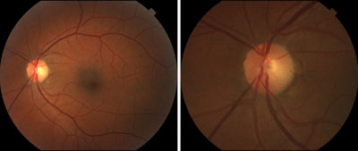 Figure 1. Fundus and optic nerve exams of the left eye were essentially normal.