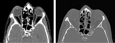 Figure 2. CT imaging of the orbits showed no evidence of direct optic nerve injury.