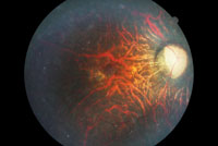 Figure 1. This patient has retinitis pigmentosa with extensive damage to the retina