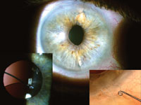 Figure 2. This patient underwent cataract surgery years ago with sulcus placement of a three-piece IOL