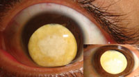 Figure 3. This patient had a history of traumatic cataract development years ago