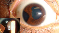 Figure 4. This 25-year-old woman was involved in a car accident in which the deploying airbags caused ocular injury.