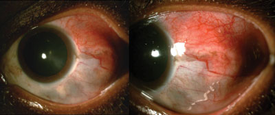 Figure 1. Clinical photograph of case 1 showing the nodular scleritis and inferior areas of scleral thinning.