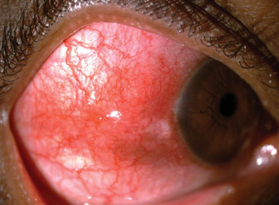 Figure 2. Clinical photograph of case 2 showing the acute inflammatory nodular scleritis 