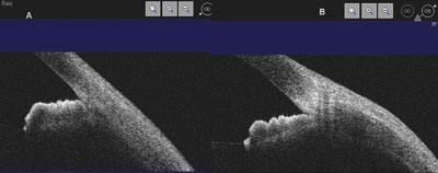 Figure 3. Anterior segment OCT of case 1